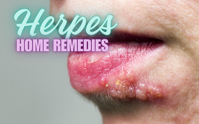 Herpes Home Remedies: Your Essential Guide for Relief