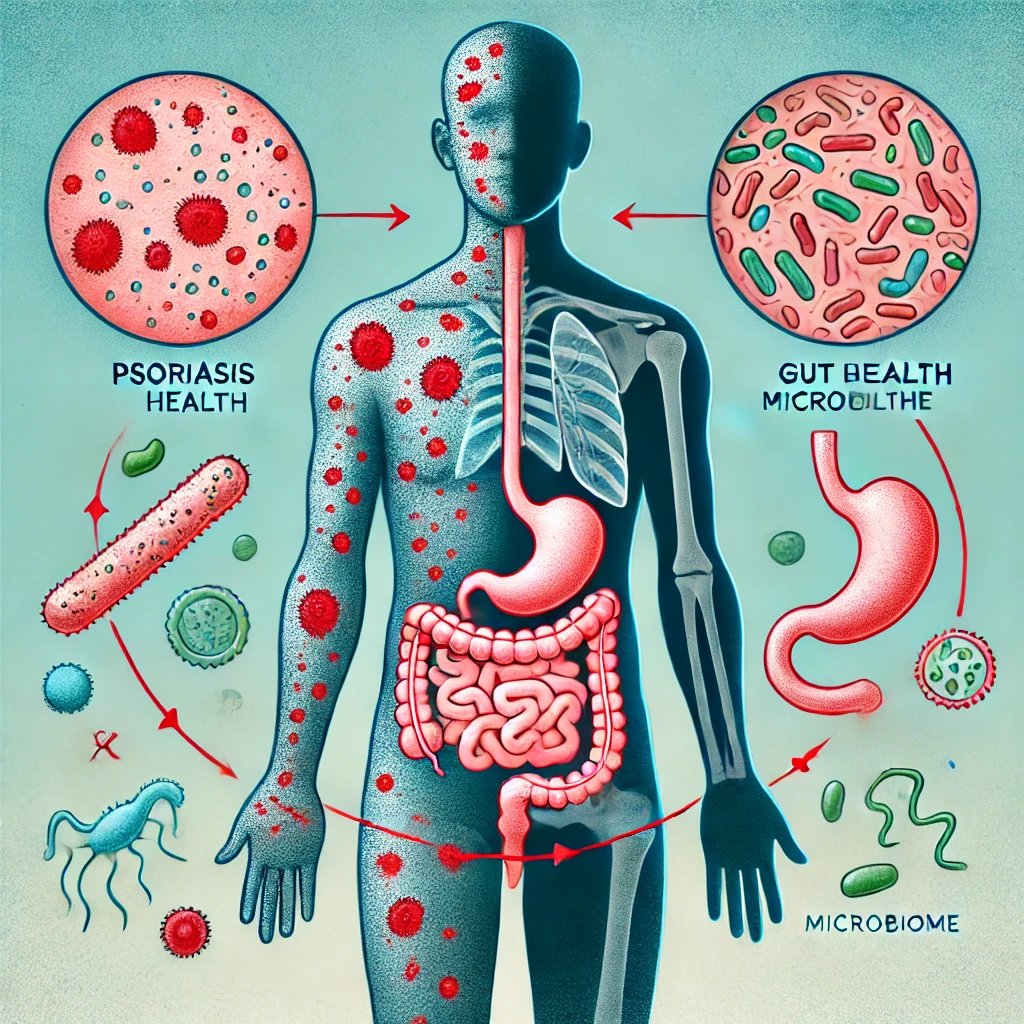 Psoriasis and Gut Health