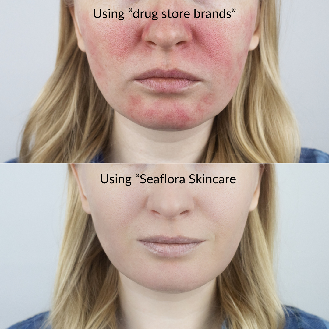 Eczema, Psoriasis, Rosacea: Symptoms, Causes, and Solutions - Seaflora 